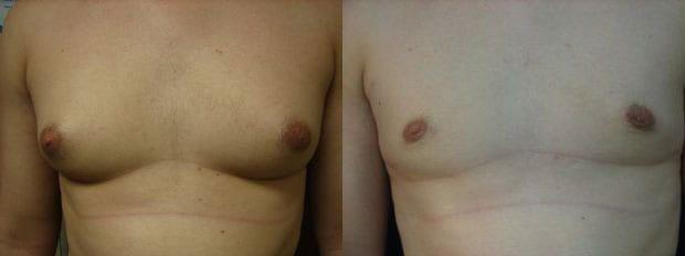 Gynecomastia Surgery result at Westfield Plastic Surgery Center in Omaha, NE