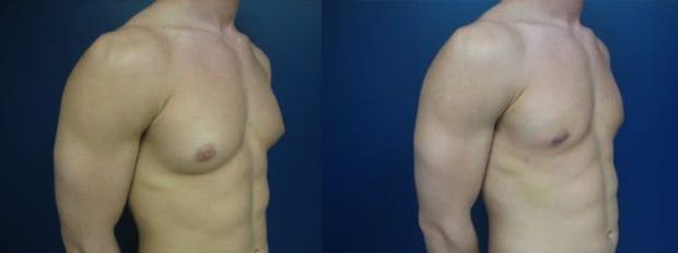 Gynecomastia Surgery result at Westfield Plastic Surgery Center in Omaha, NE