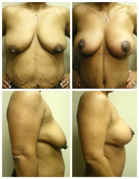 Breast Lift result at Birmingham Cosmetic Surgery | Dr. Rifai in Southfield, MI