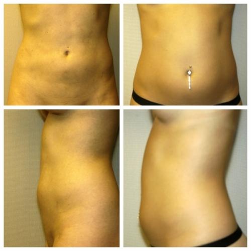 Liposuction result at Birmingham Cosmetic Surgery | Dr. Rifai in Southfield, MI