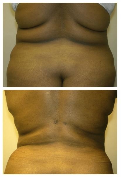 Liposuction result at Birmingham Cosmetic Surgery | Dr. Rifai in Southfield, MI