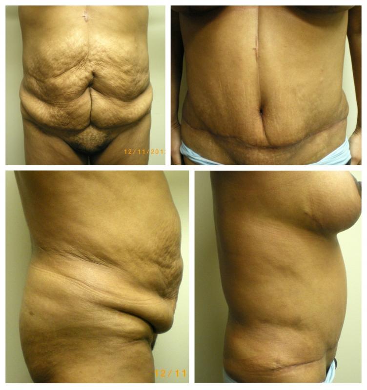 Birmingham Cosmetic Surgery | Dr. Rifai tummy tuck result — Southfield, MI