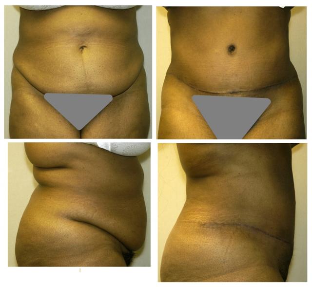 Mini Tummy Tuck result at Birmingham Cosmetic Surgery | Dr. Rifai in Southfield, MI