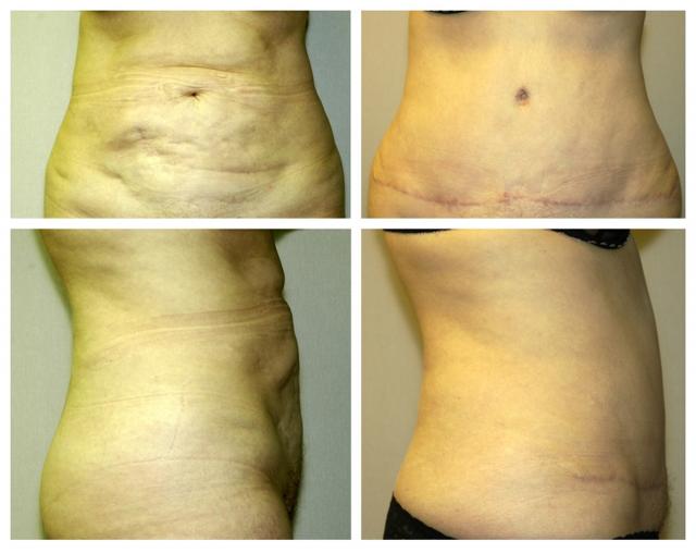 Tummy Tuck result at Birmingham Cosmetic Surgery | Dr. Rifai in Southfield, MI