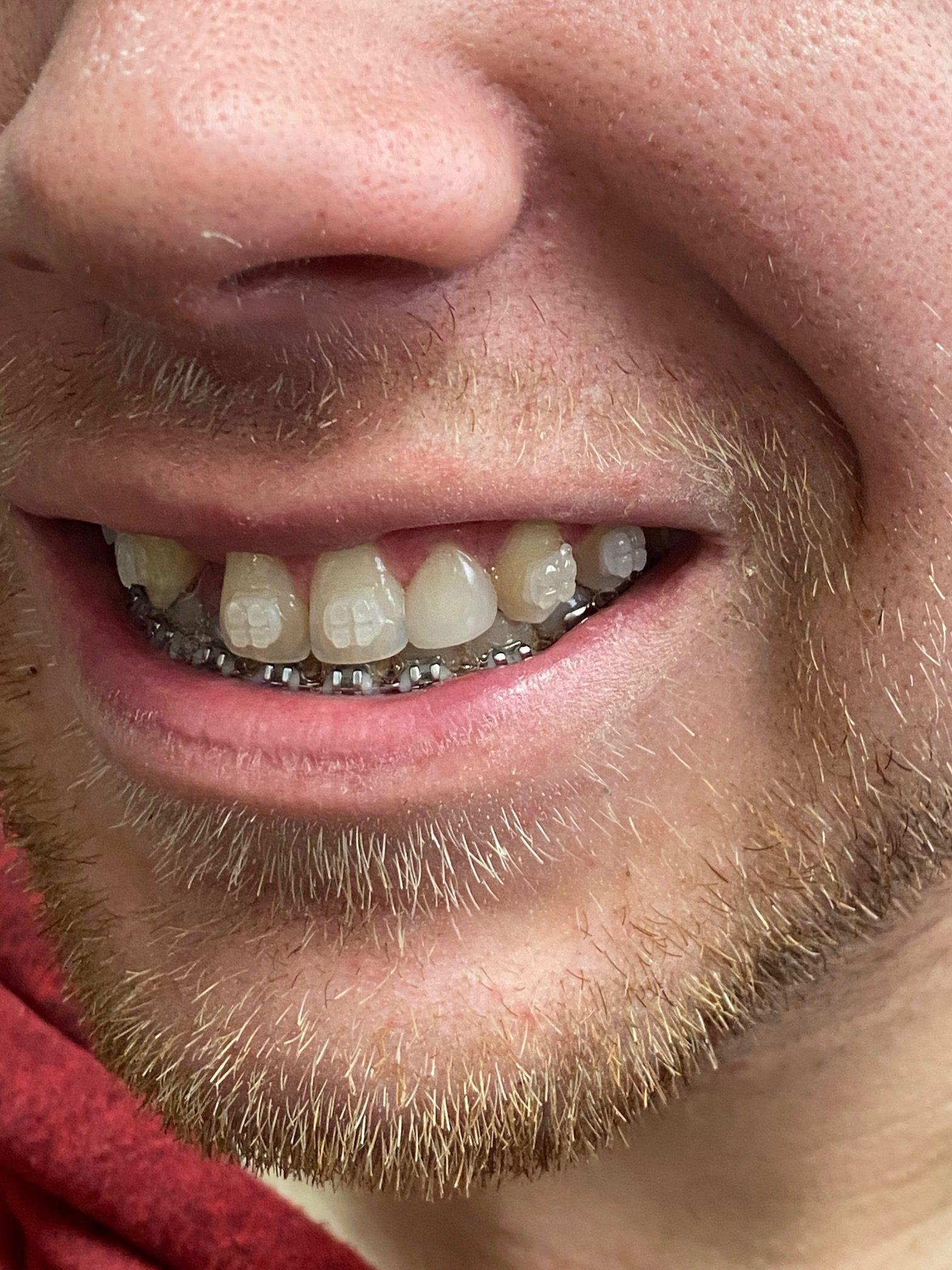 Gunnell Family Dentistry veneers after — Logan, UT