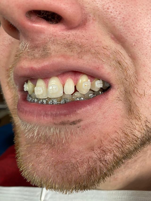 Dental Veneers before at Gunnell Family Dentistry in Logan, UT