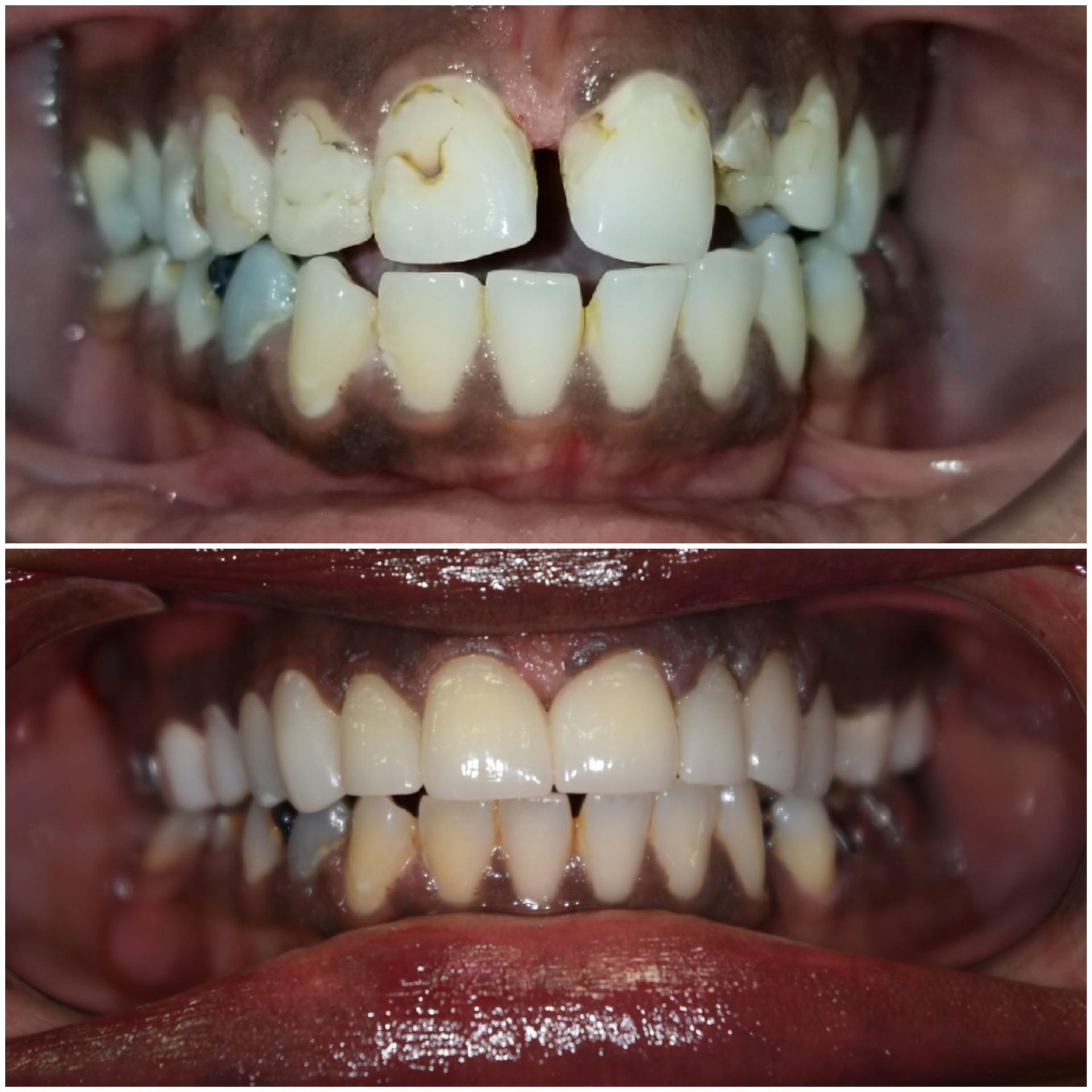 Gunnell Family Dentistry dental crowns result — Logan, UT