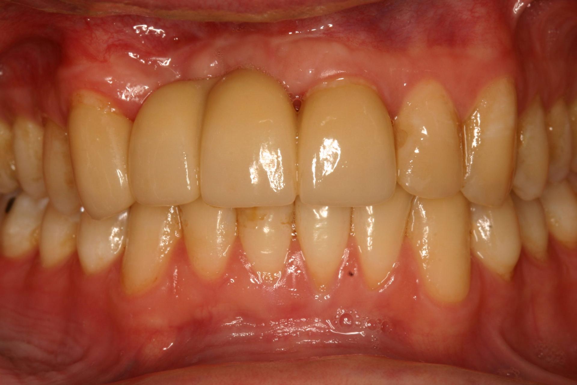 Gunnell Family Dentistry veneers after — Logan, UT