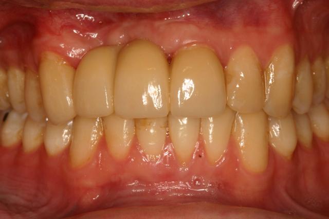 Dental Crowns after at Gunnell Family Dentistry in Logan, UT