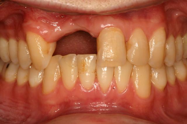 Dental Crowns before at Gunnell Family Dentistry in Logan, UT