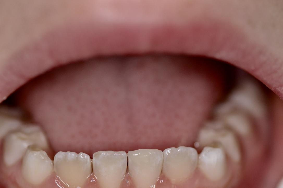 Gunnell Family Dentistry veneers after — Logan, UT