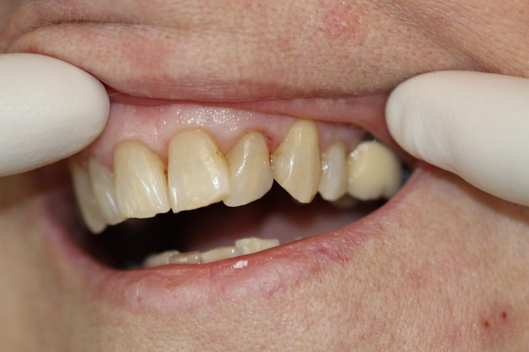 Gunnell Family Dentistry veneers after — Logan, UT
