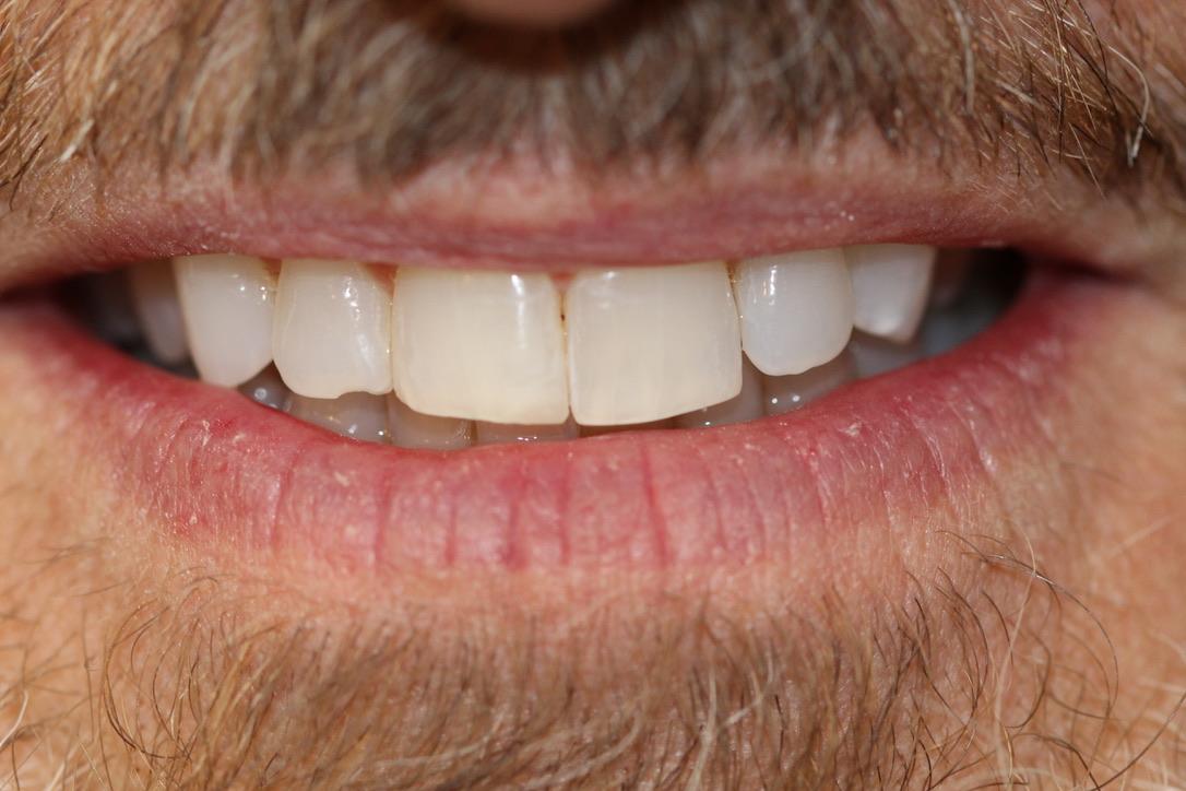 Gunnell Family Dentistry veneers after — Logan, UT