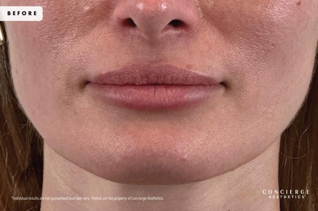 Lip Filler before at Concierge Aesthetics® - Botox, Dysport, CoolPeel, Juvederm, Laser, Morpheus8, Restylane, Xeomin in Irvine, CA