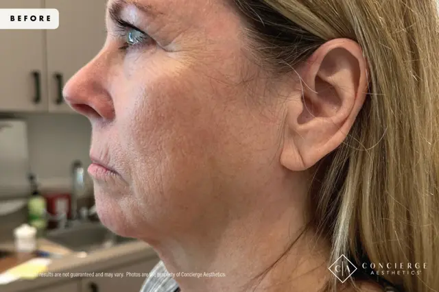 Jawline Filler before at Concierge Aesthetics® - Botox, Dysport, CoolPeel, Juvederm, Laser, Morpheus8, Restylane, Xeomin in Irvine, CA