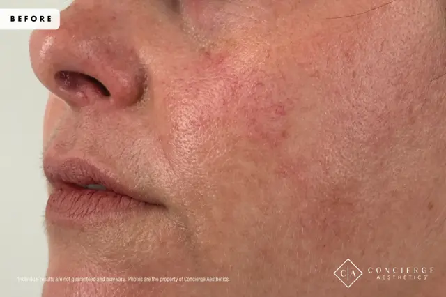 Laser Skin Resurfacing before at Concierge Aesthetics® - Botox, Dysport, CoolPeel, Juvederm, Laser, Morpheus8, Restylane, Xeomin in Irvine, CA