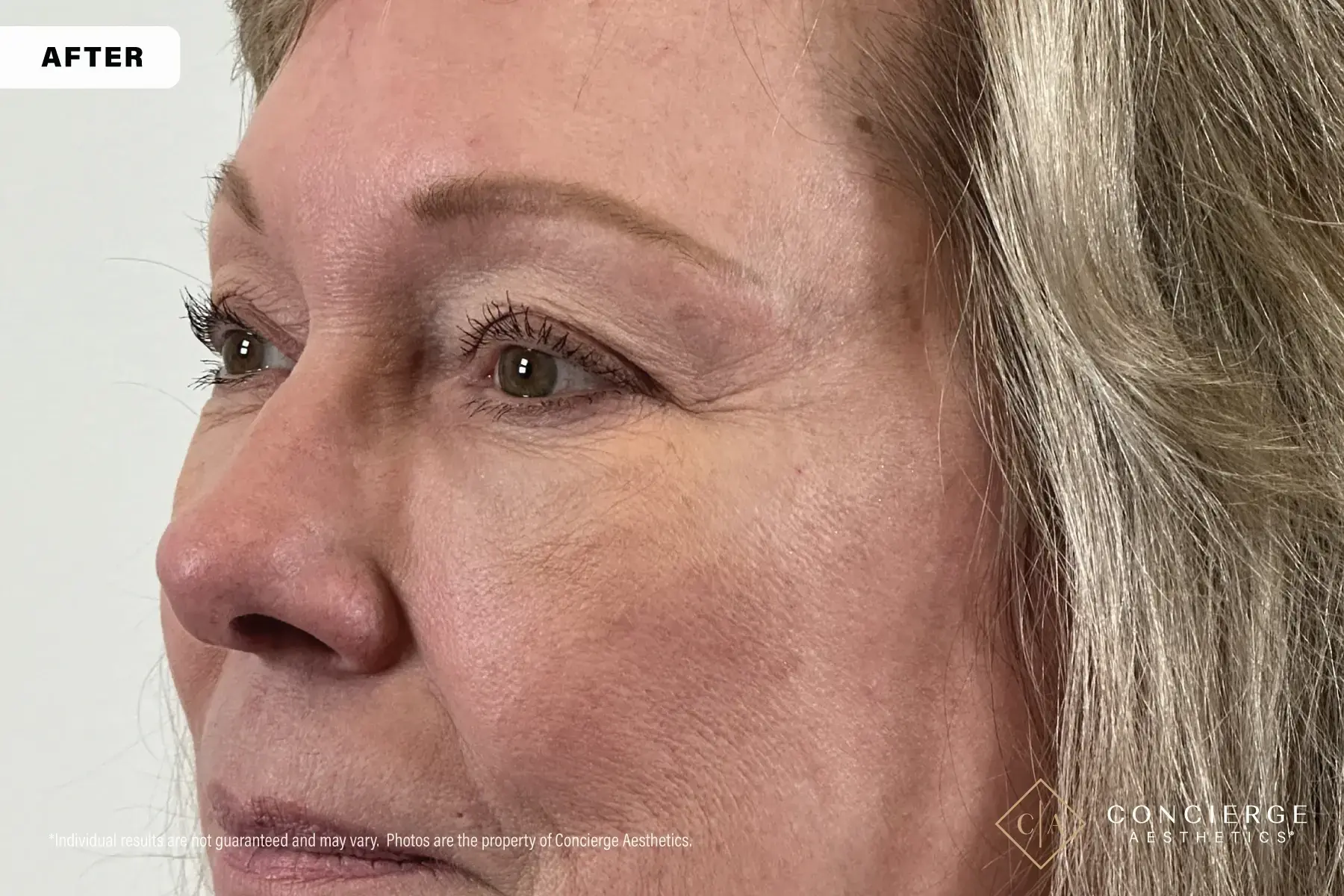 Concierge Aesthetics® - Botox, Dysport, CoolPeel, Juvederm, Laser, Morpheus8, Restylane, Xeomin undereye filler after — Irvine, CA