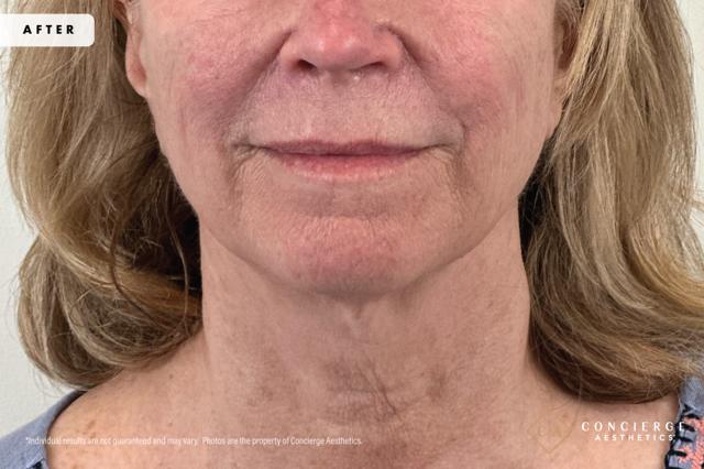 Laser Skin Resurfacing after at Concierge Aesthetics® - Botox, Dysport, CoolPeel, Juvederm, Laser, Morpheus8, Restylane, Xeomin in Irvine, CA