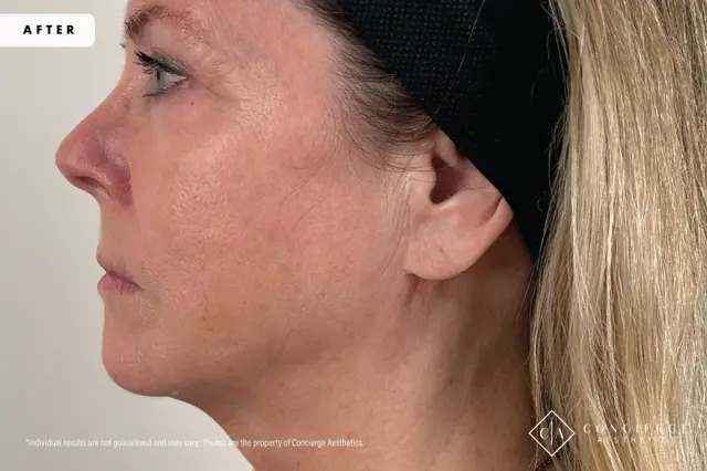 Jawline Filler after at Concierge Aesthetics® - Botox, Dysport, CoolPeel, Juvederm, Laser, Morpheus8, Restylane, Xeomin in Irvine, CA