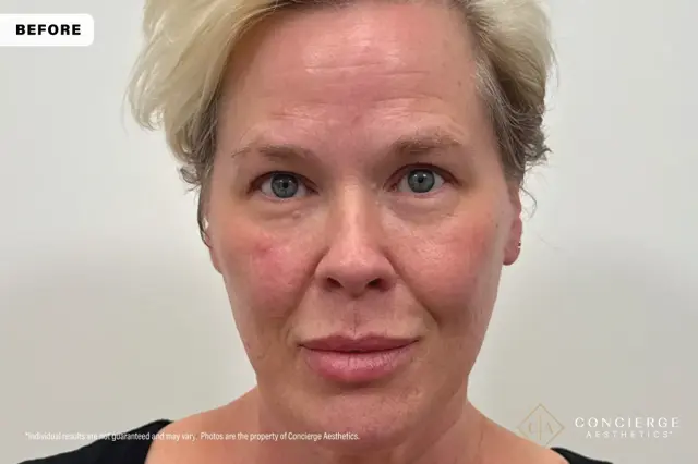 Jawline Filler before at Concierge Aesthetics® - Botox, Dysport, CoolPeel, Juvederm, Laser, Morpheus8, Restylane, Xeomin in Irvine, CA