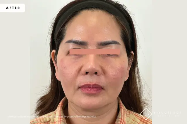 Laser Skin Resurfacing after at Concierge Aesthetics® - Botox, Dysport, CoolPeel, Juvederm, Laser, Morpheus8, Restylane, Xeomin in Irvine, CA