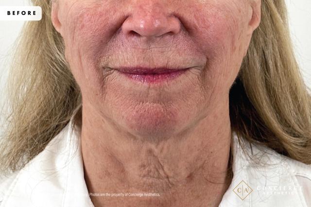 Laser Skin Resurfacing before at Concierge Aesthetics® - Botox, Dysport, CoolPeel, Juvederm, Laser, Morpheus8, Restylane, Xeomin in Irvine, CA