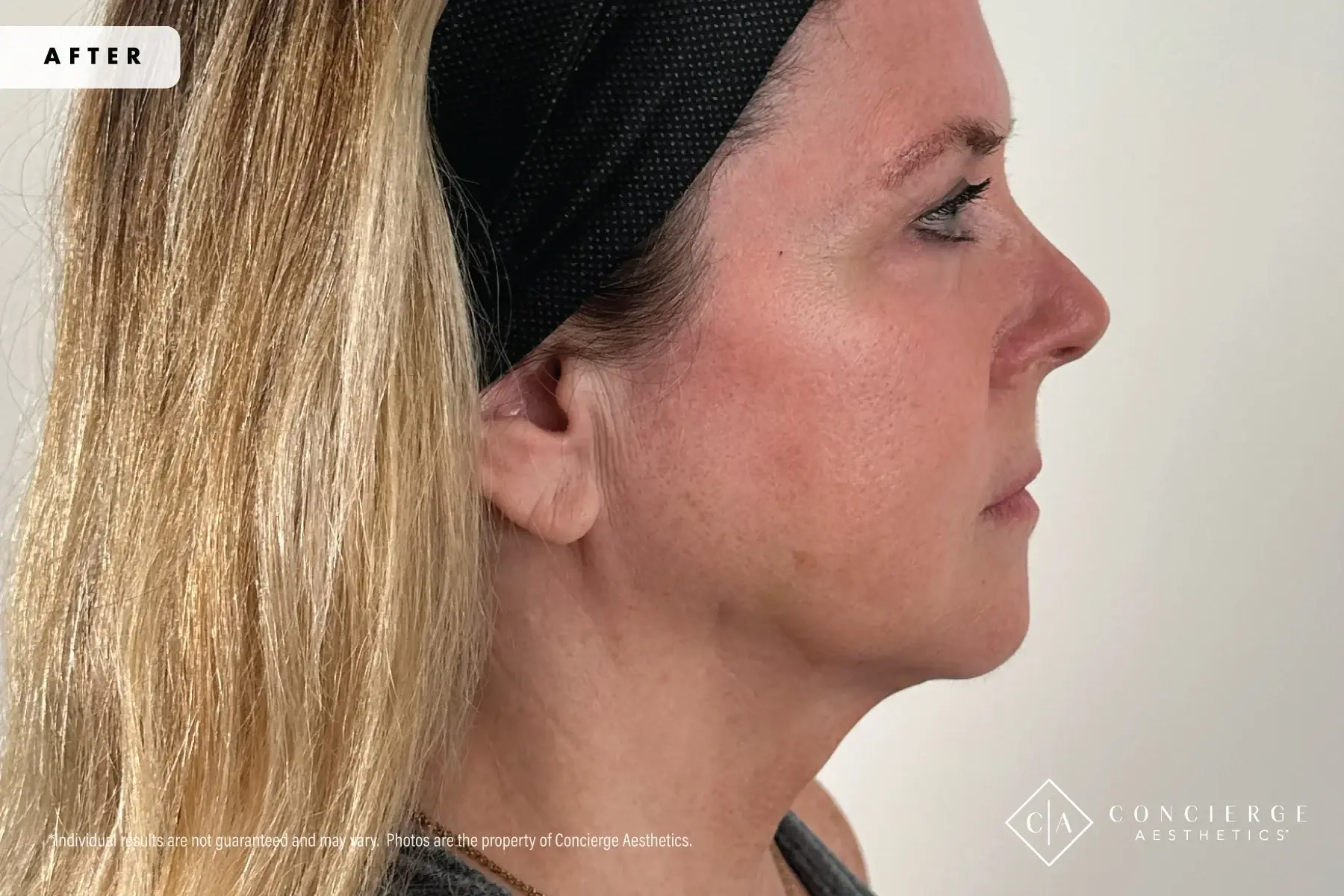 Concierge Aesthetics® - Botox, Dysport, CoolPeel, Juvederm, Laser, Morpheus8, Restylane, Xeomin cheek filler after — Irvine, CA