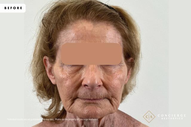 Laser Skin Resurfacing before at Concierge Aesthetics® - Botox, Dysport, CoolPeel, Juvederm, Laser, Morpheus8, Restylane, Xeomin in Irvine, CA