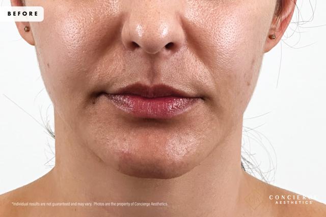 Lip Filler before at Concierge Aesthetics® - Botox, Dysport, CoolPeel, Juvederm, Laser, Morpheus8, Restylane, Xeomin in Irvine, CA