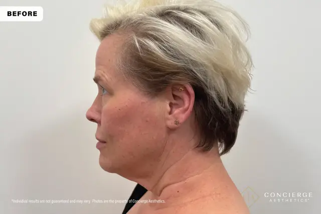 Jawline Filler before at Concierge Aesthetics® - Botox, Dysport, CoolPeel, Juvederm, Laser, Morpheus8, Restylane, Xeomin in Irvine, CA