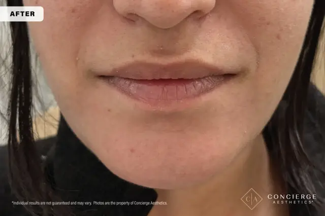 Botox after at Concierge Aesthetics® - Botox, Dysport, CoolPeel, Juvederm, Laser, Morpheus8, Restylane, Xeomin in Irvine, CA