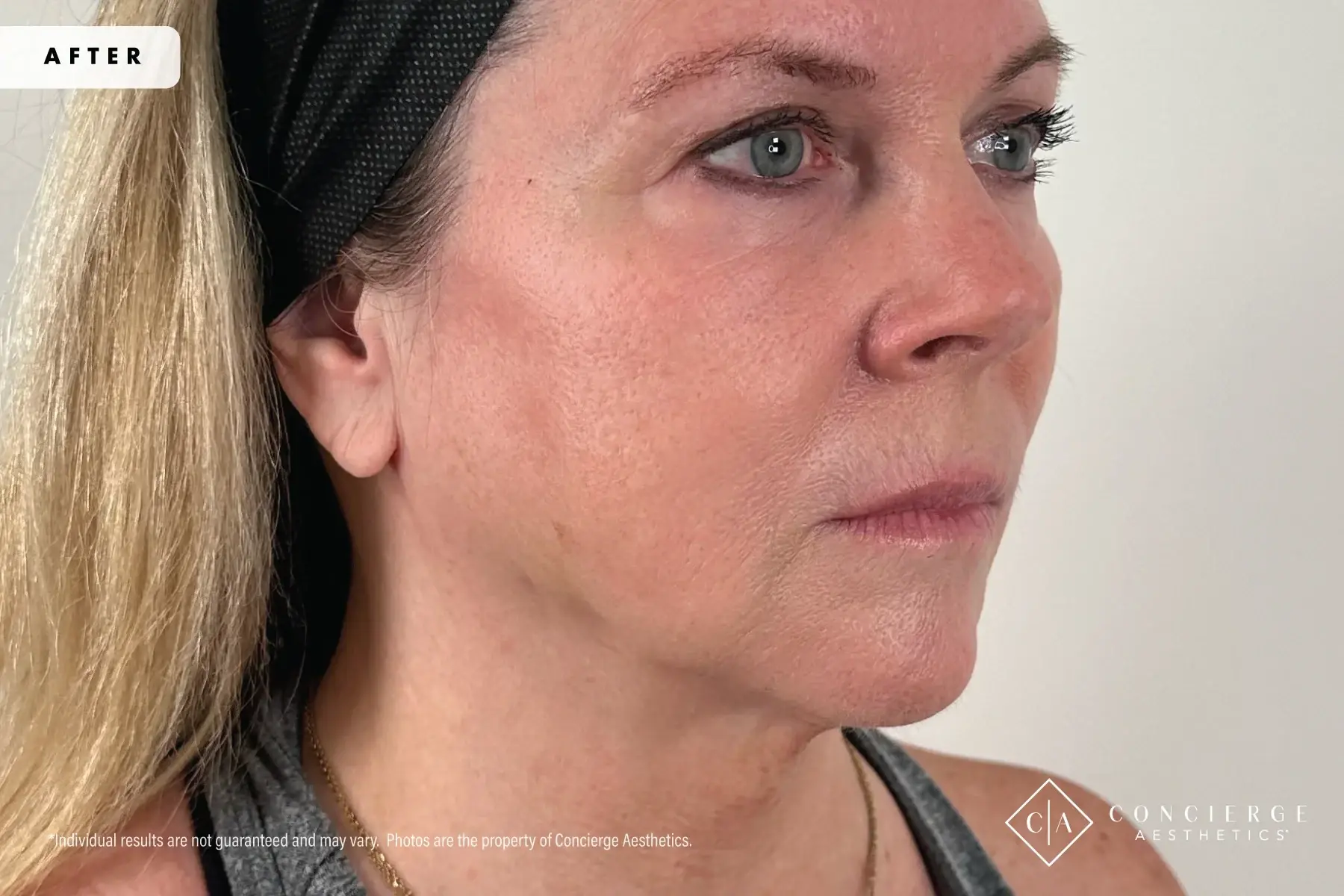 Concierge Aesthetics® - Botox, Dysport, CoolPeel, Juvederm, Laser, Morpheus8, Restylane, Xeomin cheek filler after — Irvine, CA