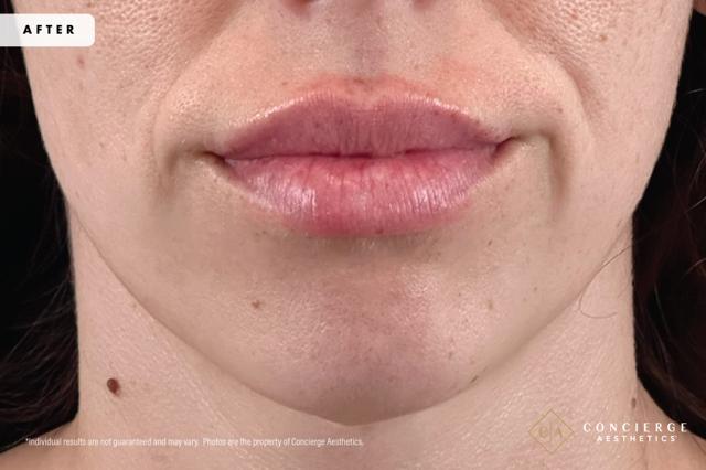 Lip Filler after at Concierge Aesthetics® - Botox, Dysport, CoolPeel, Juvederm, Laser, Morpheus8, Restylane, Xeomin in Irvine, CA