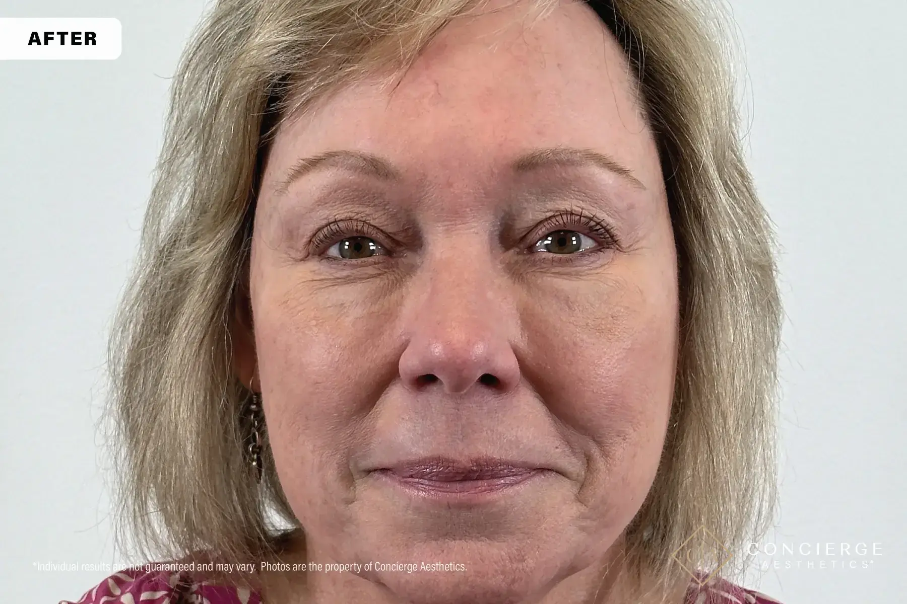 Concierge Aesthetics® - Botox, Dysport, CoolPeel, Juvederm, Laser, Morpheus8, Restylane, Xeomin undereye filler after — Irvine, CA