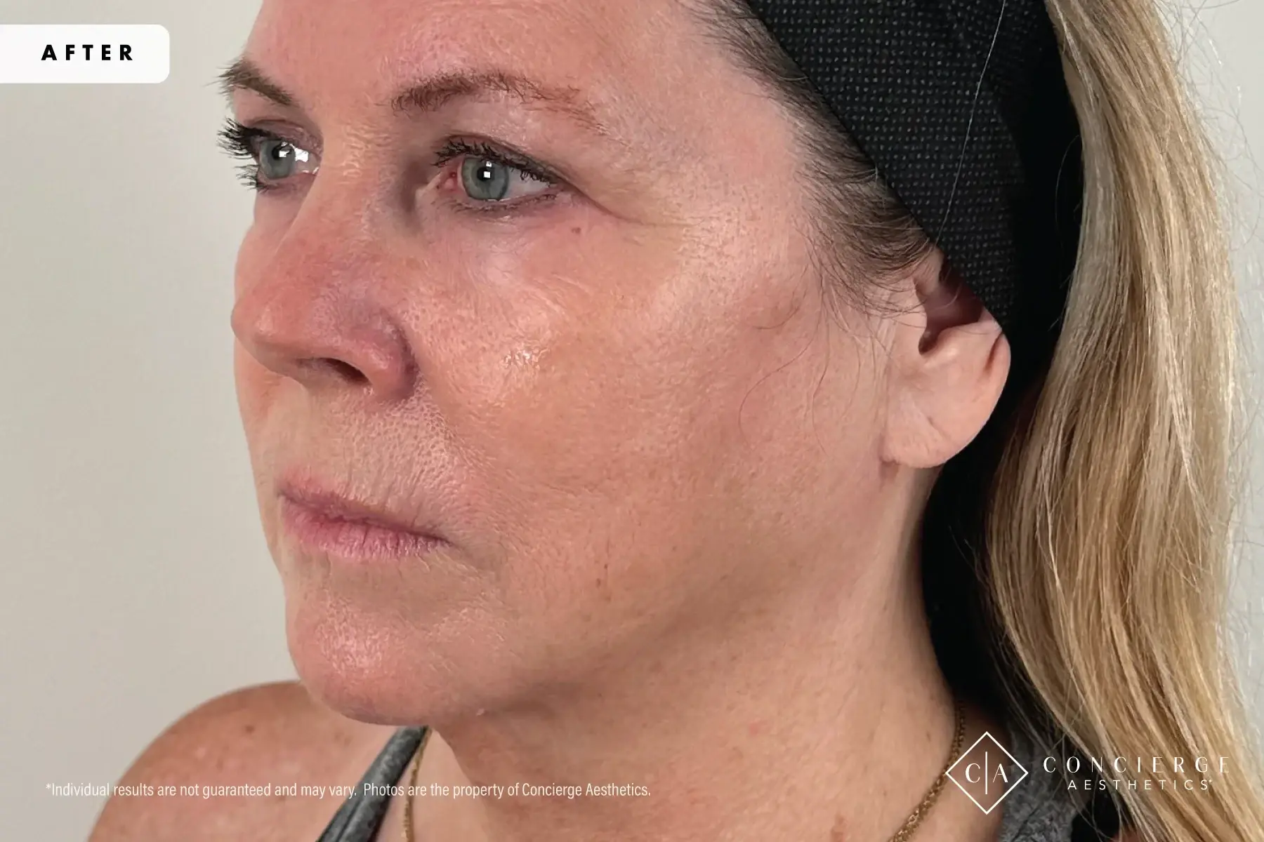 Concierge Aesthetics® - Botox, Dysport, CoolPeel, Juvederm, Laser, Morpheus8, Restylane, Xeomin cheek filler after — Irvine, CA