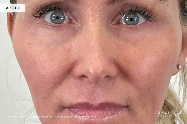 Laser Skin Resurfacing after at Concierge Aesthetics® - Botox, Dysport, CoolPeel, Juvederm, Laser, Morpheus8, Restylane, Xeomin in Irvine, CA