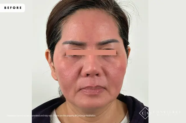 Laser Skin Resurfacing before at Concierge Aesthetics® - Botox, Dysport, CoolPeel, Juvederm, Laser, Morpheus8, Restylane, Xeomin in Irvine, CA