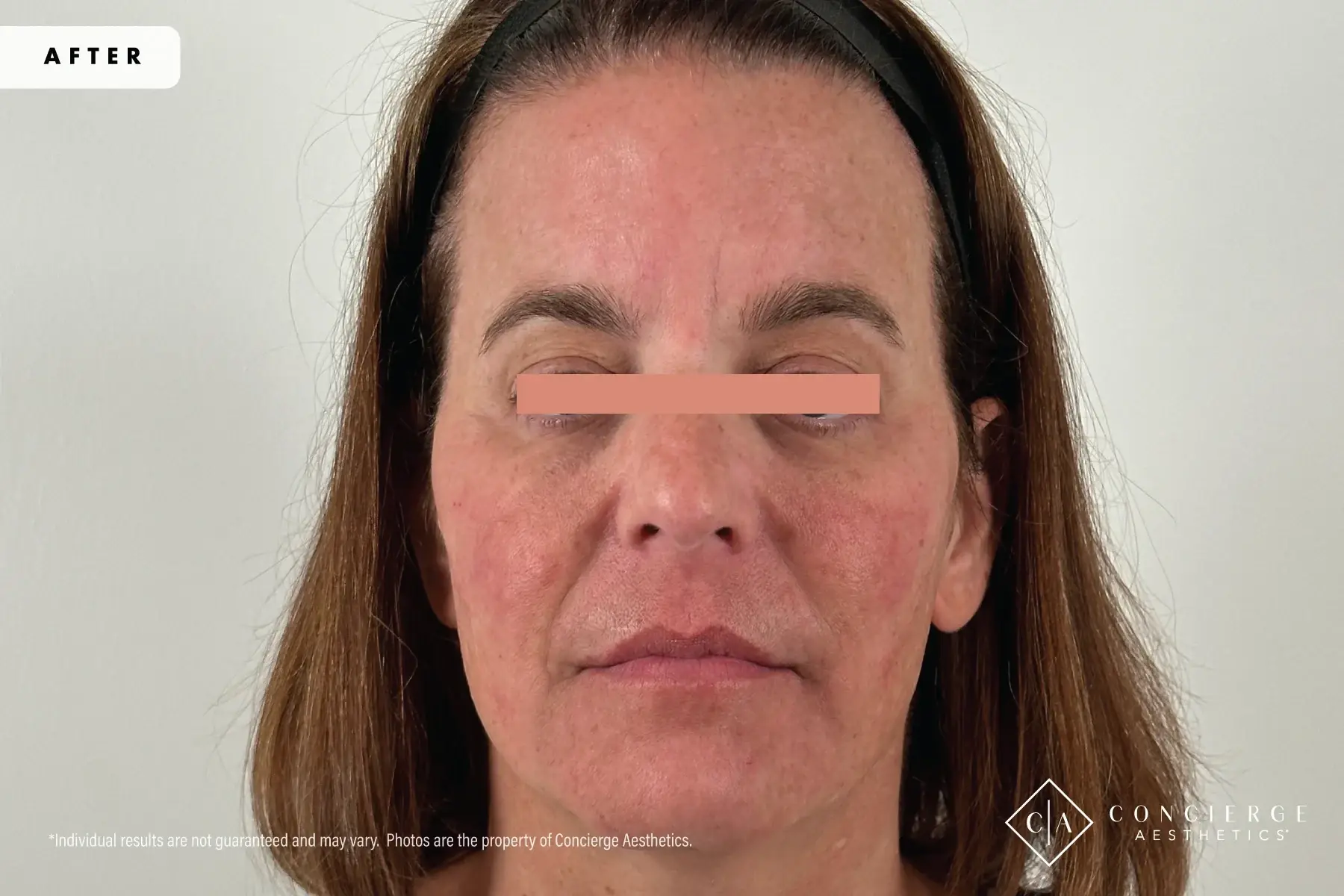 Concierge Aesthetics® - Botox, Dysport, CoolPeel, Juvederm, Laser, Morpheus8, Restylane, Xeomin cheek filler after — Irvine, CA