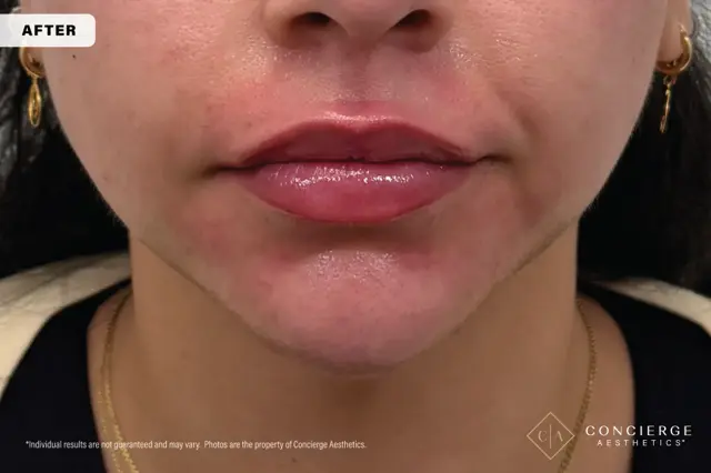 Jawline Filler after at Concierge Aesthetics® - Botox, Dysport, CoolPeel, Juvederm, Laser, Morpheus8, Restylane, Xeomin in Irvine, CA