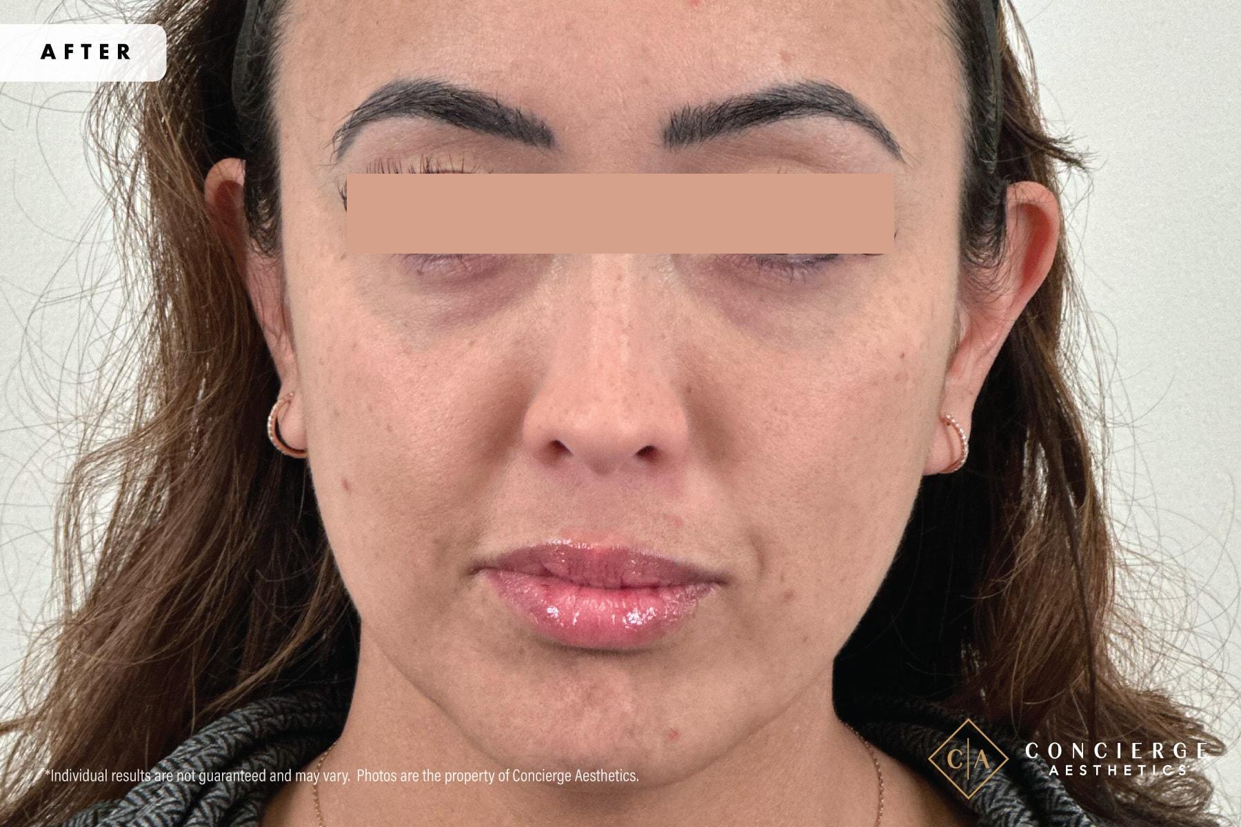 Concierge Aesthetics® - Botox, Dysport, CoolPeel, Juvederm, Laser, Morpheus8, Restylane, Xeomin undereye filler after — Irvine, CA