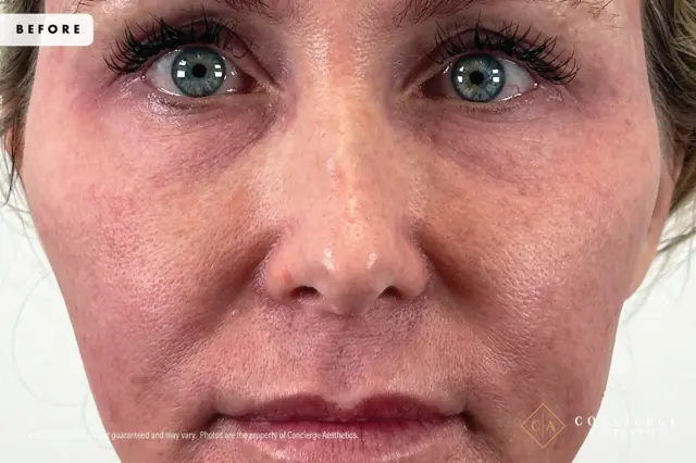 Laser Skin Resurfacing before at Concierge Aesthetics® - Botox, Dysport, CoolPeel, Juvederm, Laser, Morpheus8, Restylane, Xeomin in Irvine, CA