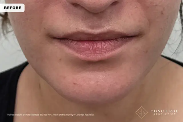 Botox before at Concierge Aesthetics® - Botox, Dysport, CoolPeel, Juvederm, Laser, Morpheus8, Restylane, Xeomin in Irvine, CA