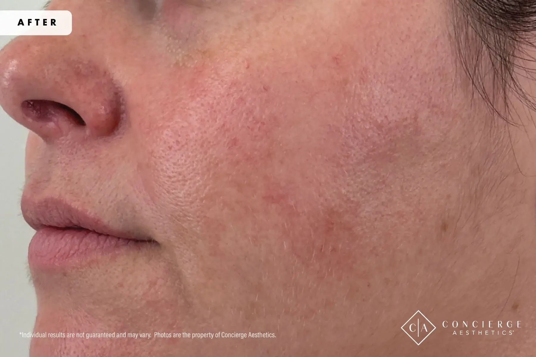 Concierge Aesthetics® - Botox, Dysport, CoolPeel, Juvederm, Laser, Morpheus8, Restylane, Xeomin photofacial after — Irvine, CA
