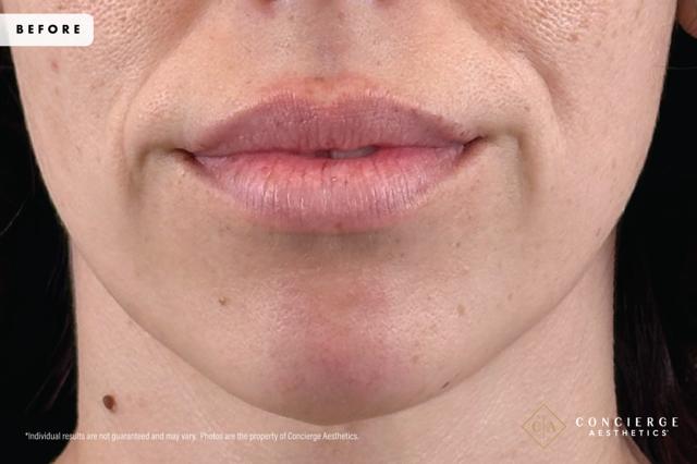 Lip Filler before at Concierge Aesthetics® - Botox, Dysport, CoolPeel, Juvederm, Laser, Morpheus8, Restylane, Xeomin in Irvine, CA