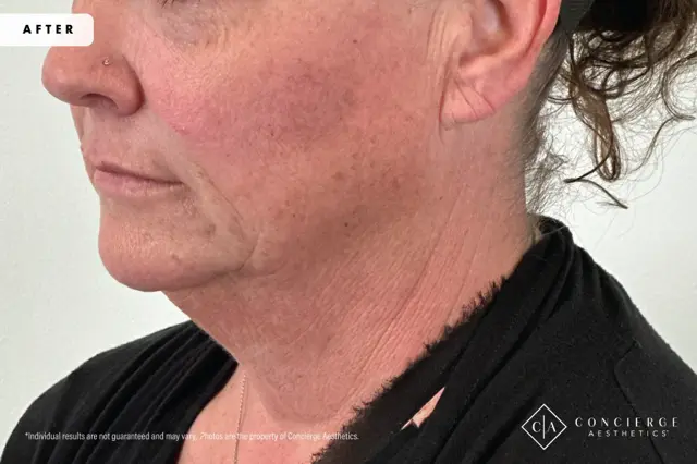 Jawline Filler after at Concierge Aesthetics® - Botox, Dysport, CoolPeel, Juvederm, Laser, Morpheus8, Restylane, Xeomin in Irvine, CA