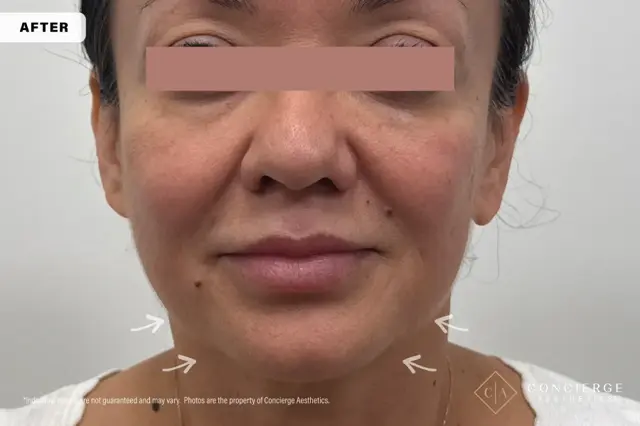 Botox after at Concierge Aesthetics® - Botox, Dysport, CoolPeel, Juvederm, Laser, Morpheus8, Restylane, Xeomin in Irvine, CA