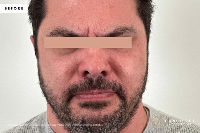 Botox before at Concierge Aesthetics® - Botox, Dysport, CoolPeel, Juvederm, Laser, Morpheus8, Restylane, Xeomin in Irvine, CA