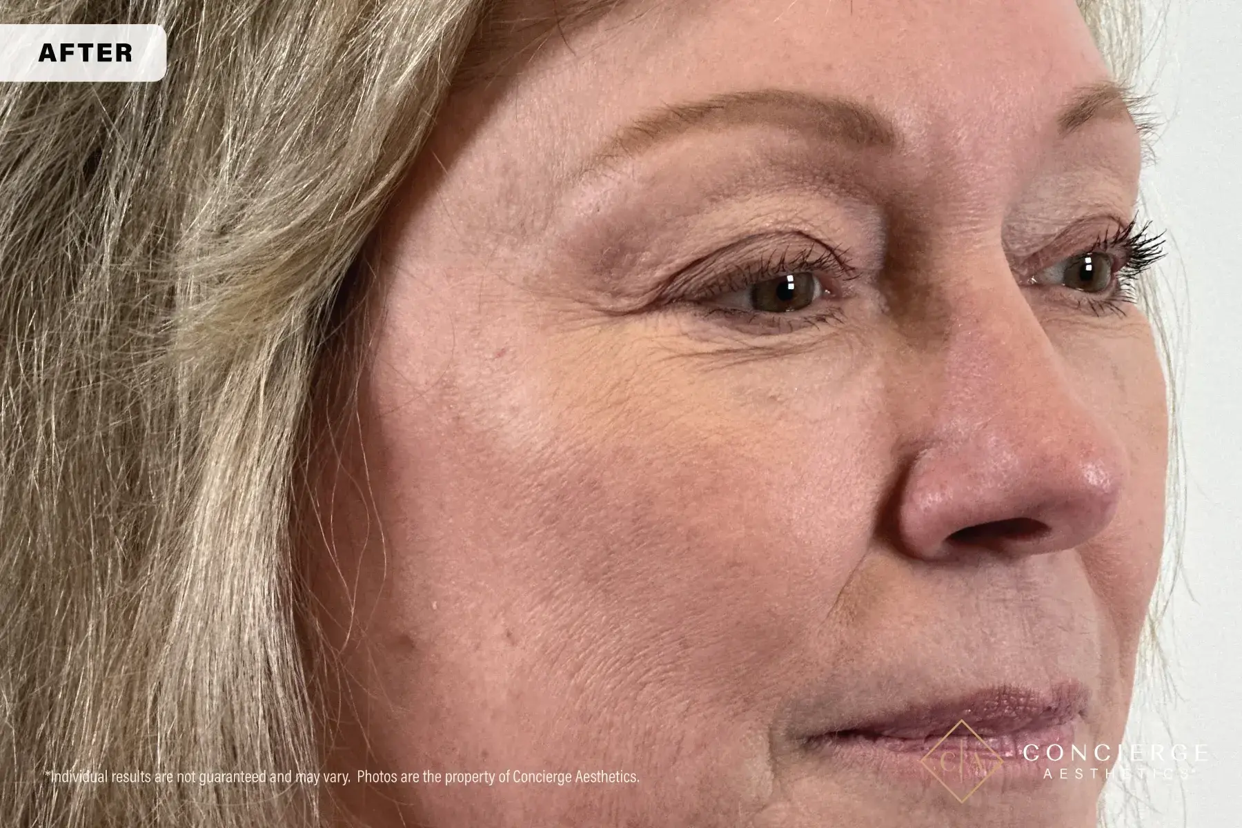 Concierge Aesthetics® - Botox, Dysport, CoolPeel, Juvederm, Laser, Morpheus8, Restylane, Xeomin undereye filler after — Irvine, CA