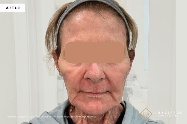 Laser Skin Resurfacing after at Concierge Aesthetics® - Botox, Dysport, CoolPeel, Juvederm, Laser, Morpheus8, Restylane, Xeomin in Irvine, CA