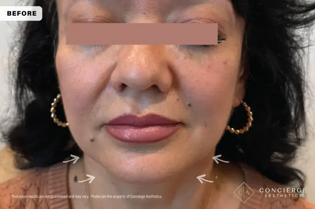 Botox before at Concierge Aesthetics® - Botox, Dysport, CoolPeel, Juvederm, Laser, Morpheus8, Restylane, Xeomin in Irvine, CA